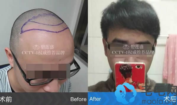 小俊在北京碧莲盛植发后一年前后对比图