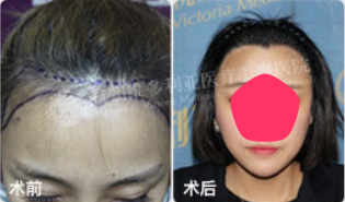 杭州维多利亚医疗美容医院植发前后效果对比图