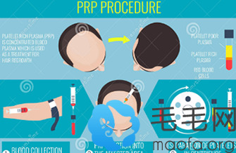 治疗脂溢性脱发的注射PRP疗法