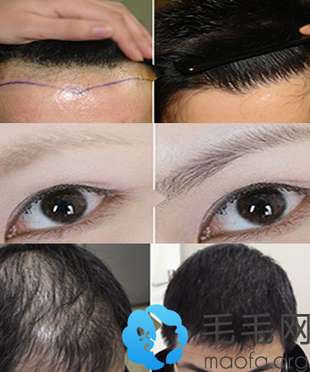 属于广州碧莲盛植发的毛发移植案例对比图
