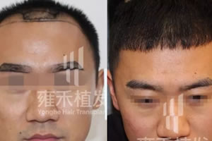 植眉效果好吗？展示北京雍禾眉毛移植效果对比图