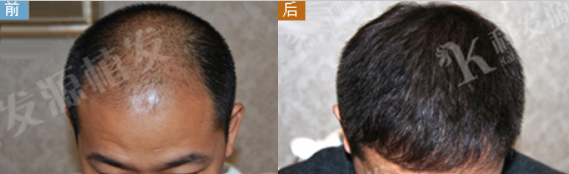 四级脱发在科发源植发4680毛囊后恢复效果