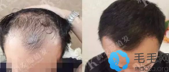 严重脱发的李先生在北京科发源种植头发15个月