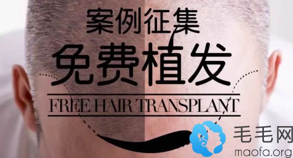 新疆整形毛发移植中心免费植发征集活动