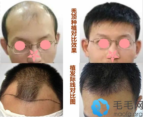 新疆整形头发种植和纹发际线前后对比效果