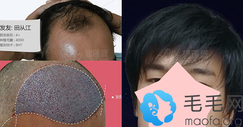 发友小田使用BHT植发技术种植3000毛囊单位术后1年效果图
