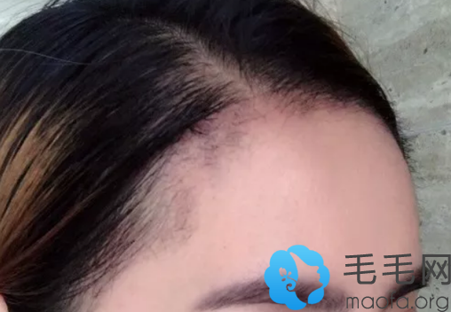 植发医生蒋云祥植发案例：植发际线后一个月效果图
