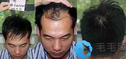 去武汉雍禾植发做头发种植前照片