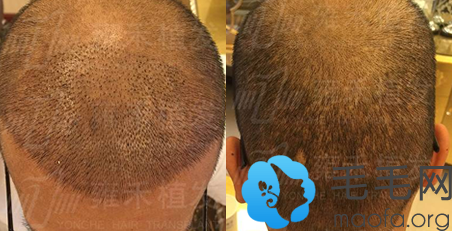 在南宁雍禾植发种植头发后第7天恢复效果图