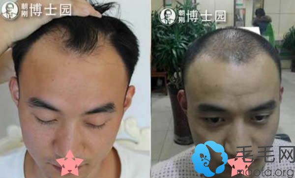 博士园秃顶种植前后对比案例