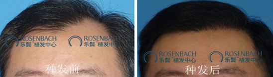 广州乐鬓毛发移植中心植发成功案例效果显示