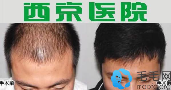 西京医院头发稀疏加密种植真实案例