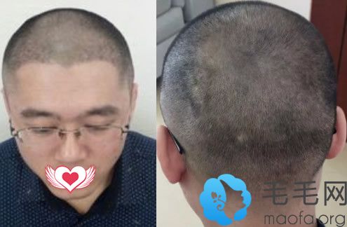 在合肥华美植发中心做额角头发种植完第10天恢复情况