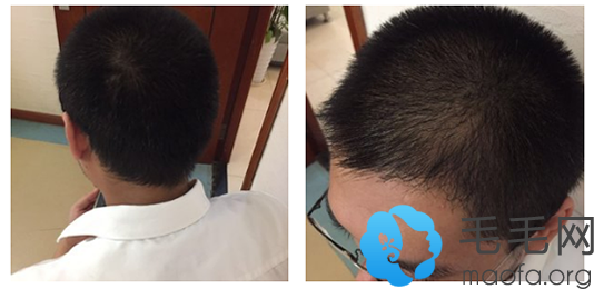 合肥华美植发中心头发移植后5个月恢复效果展示