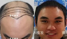 温州雍禾种植了不到3000单位的头发 能让我告别七级脱发吗