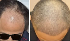 西安西京医院能植发吗 还是用毛发移植的真人案例来回答吧