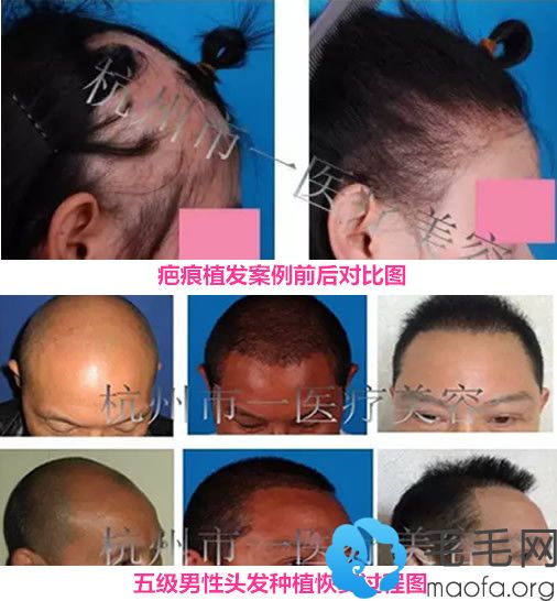 在杭州市人民医院做过的毛发移植案例