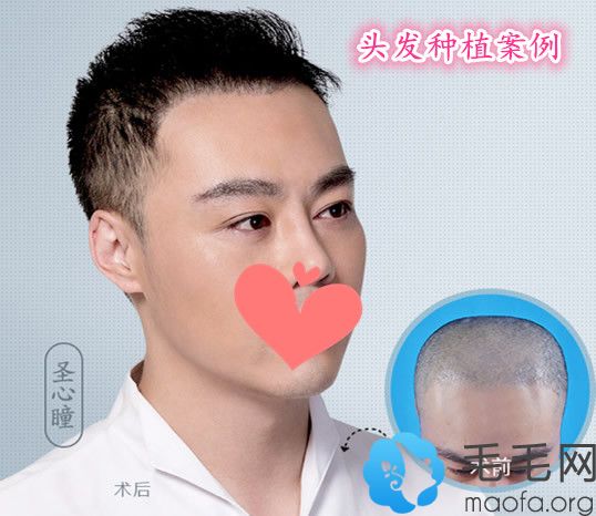 在上海美莱毛发移植中心做头发种植案例前后对比效果展示