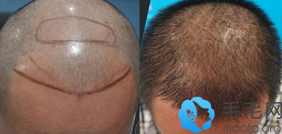 U型脱发男士在重庆东方植发做发际线种植+头发加密案例前后对比