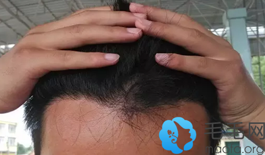 M型脱发男士去北京协和医院植发术后第8个月效果图展示