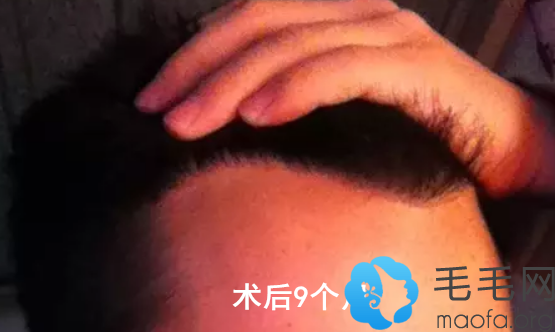 M型脱发男士找北京第三医院谢祥做发际线种植术后第9个月效果图展示