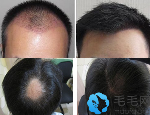 找北京协和医院朱晨雨做头发种植+疤痕种植案例效果对比图