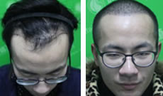 我找上海新生张春杰做植发才两个月 不知道一年后会怎样呢