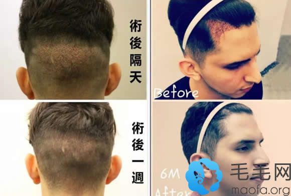 杭州美莱种植头发6个月效果图