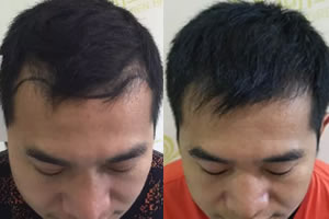 宁波同仁植发案例：M型发际线的刘老板种植头发后颜值暴涨