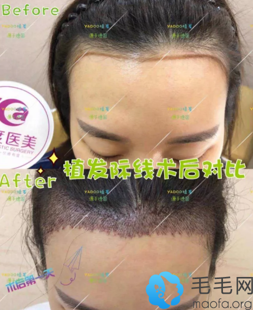 M字额头女生找广州雅度植发中心罗科义植发际线案例前后对比图