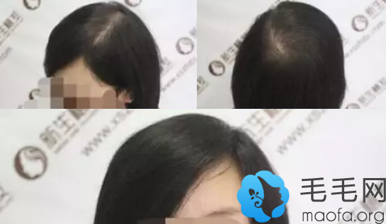 女性雄脱患者在南京新生植发植发术后11个月效果图