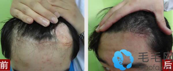 郑州欧兰胡珈宁疤痕种植前后对比案例