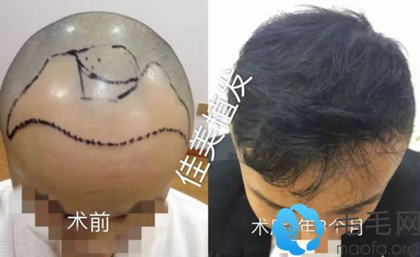 M字脱发在南昌佳美植发一年3个月的效果对比图