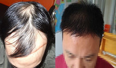 因雄脱我在郑州医德佳医院做了植发并分享2年来头发的情况