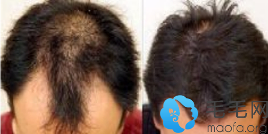 男士在郑州华山医院做头发种植+发际线种植案例前后效果对比图