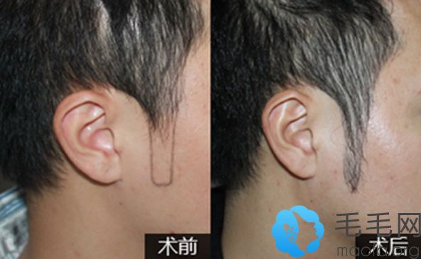 男士采用雍禾UHE艺术植发技术种植鬓角10个月的效果