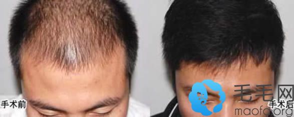 重庆西南医院头发稀疏植发案例