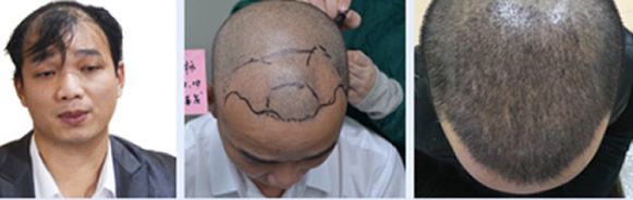 台州美莱种植发际线+头发稀疏加密三个月恢复效果图