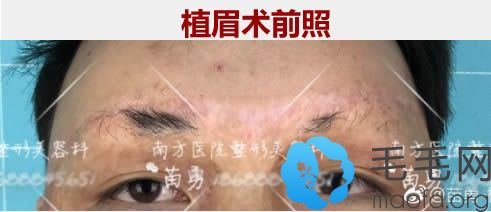 在广州南方医院种植眉毛术前照