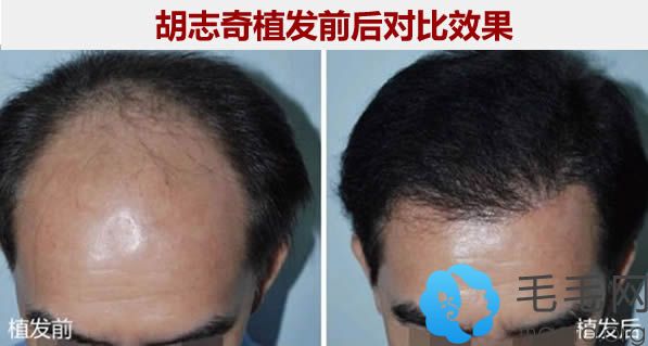 广州南方医院胡志奇植发前后对比案例