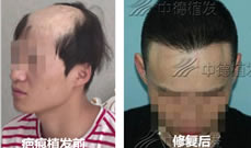 我找北京中德徐霞做疤痕植发修复 是因为她没有失败案例