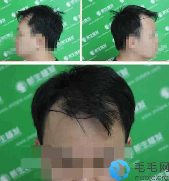 在上海新生植发种植发际线术前照