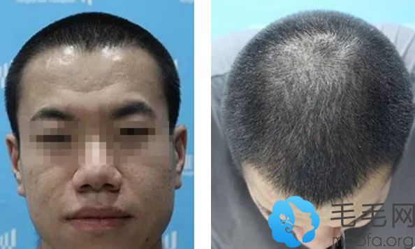 我在西安雍禾种植头发三个月恢复效果图
