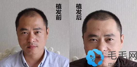 北京博士园周晚香头发种植前后对比图