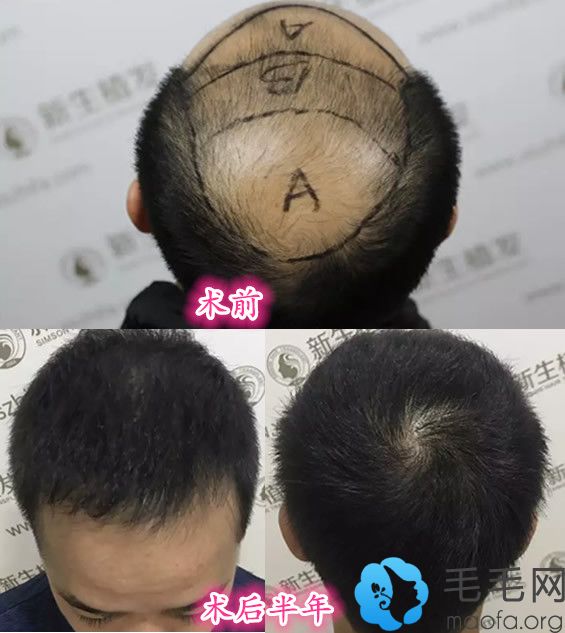 深圳新生头发种植前后对比图