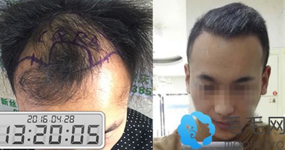 重庆仁爱医院头发种植案例对比图