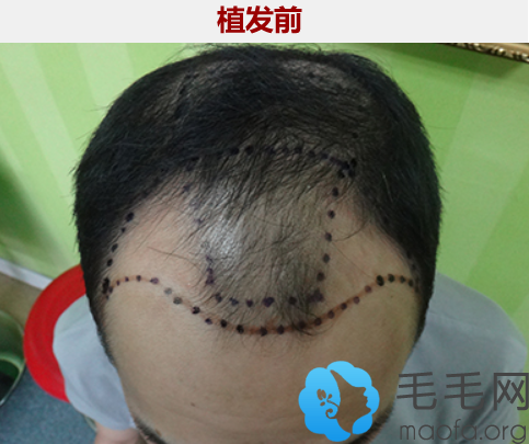 在北京博士园植发种植头发术前照