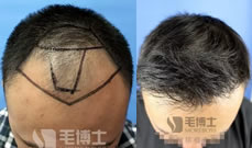 分享32岁的陈先生在宁波珈禾毛博士种植头发的亲身经历