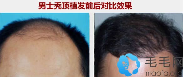 西宁韩美男士秃顶植发后前后对比效果