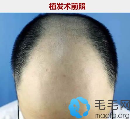 在西宁韩美植发种植头发术前照